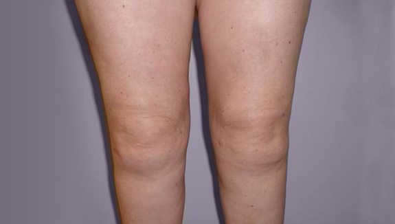 Liposukcija - nakon 6 mjeseci